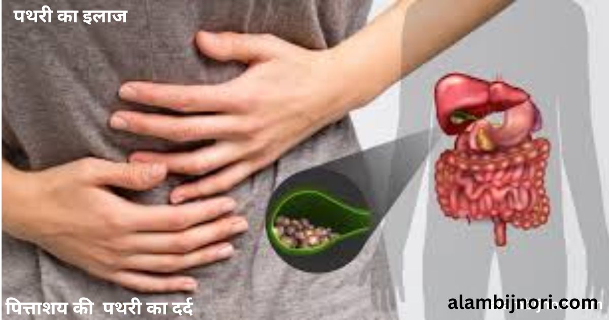 पथरी का इलाज 